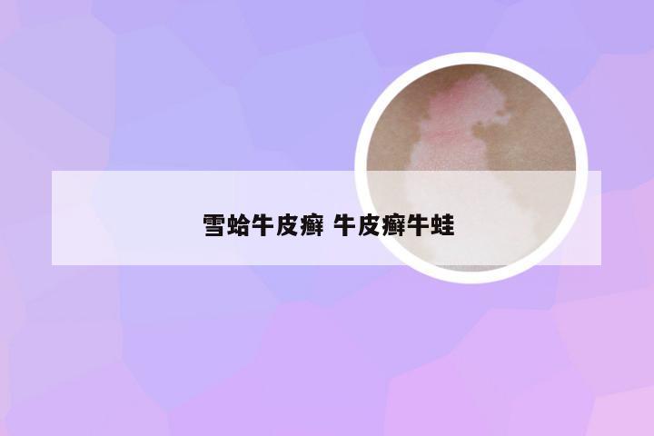 雪蛤牛皮癣 牛皮癣牛蛙