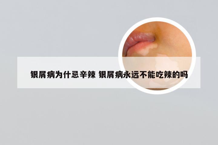银屑病为什忌辛辣 银屑病永远不能吃辣的吗