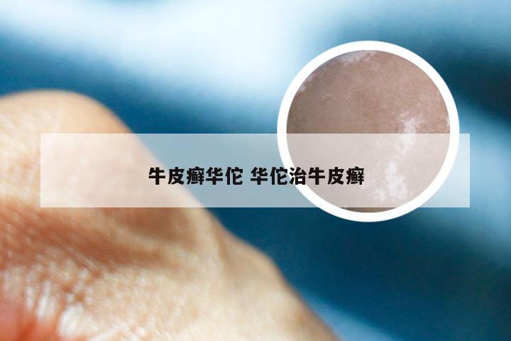 牛皮癣华佗 华佗治牛皮癣