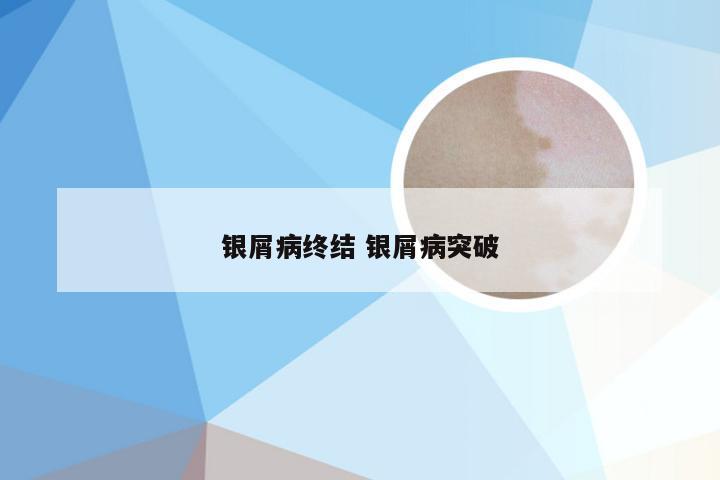 银屑病终结 银屑病突破