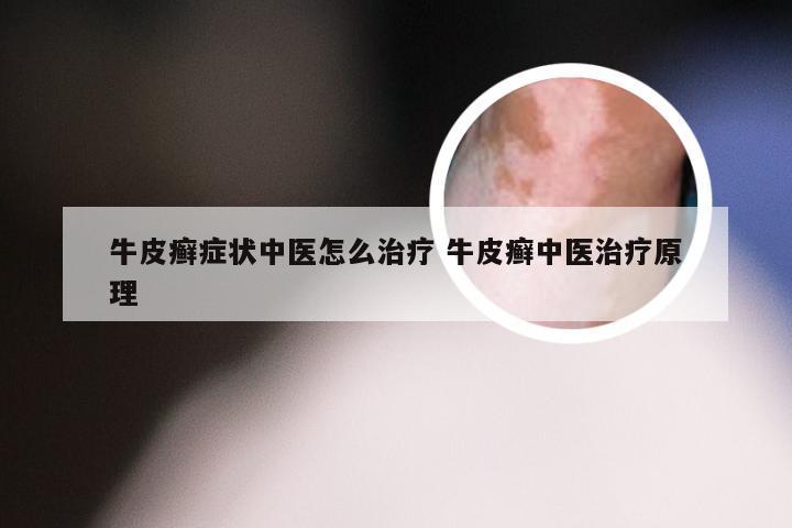 牛皮癣症状中医怎么治疗 牛皮癣中医治疗原理