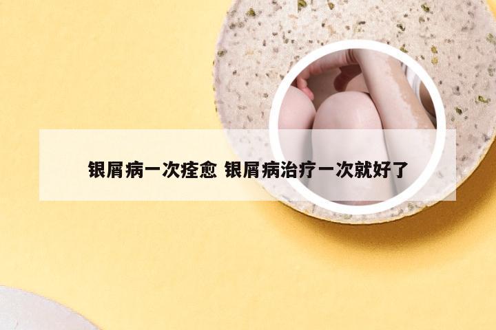 银屑病一次痊愈 银屑病治疗一次就好了