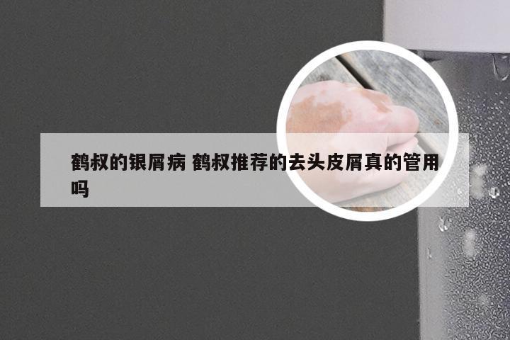 鹤叔的银屑病 鹤叔推荐的去头皮屑真的管用吗