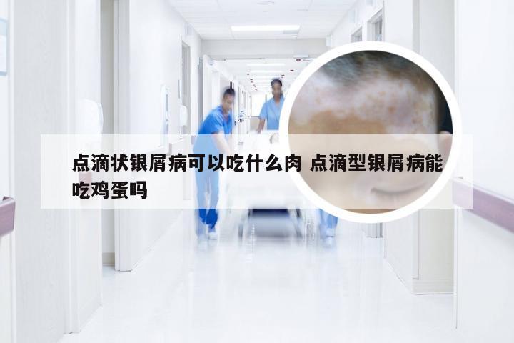 点滴状银屑病可以吃什么肉 点滴型银屑病能吃鸡蛋吗