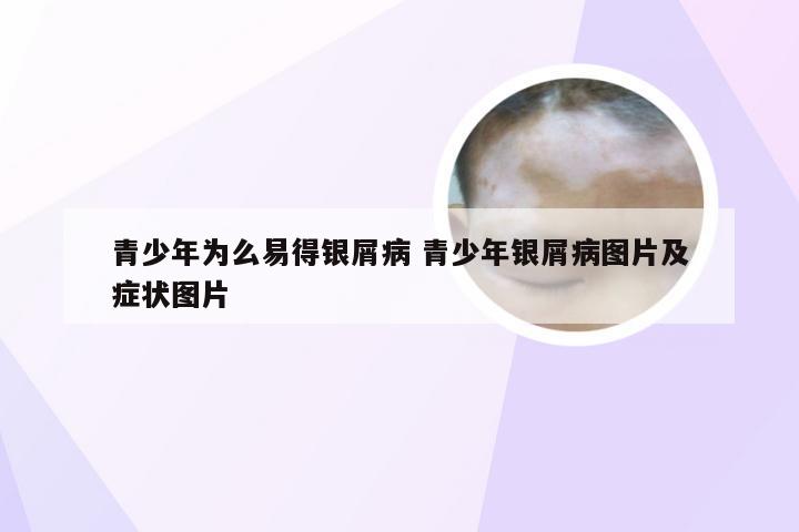 青少年为么易得银屑病 青少年银屑病图片及症状图片