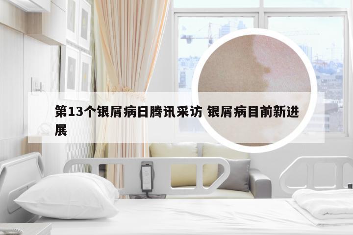 第13个银屑病日腾讯采访 银屑病目前新进展