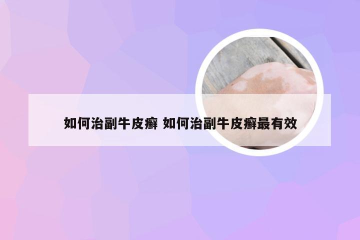 如何治副牛皮癣 如何治副牛皮癣最有效