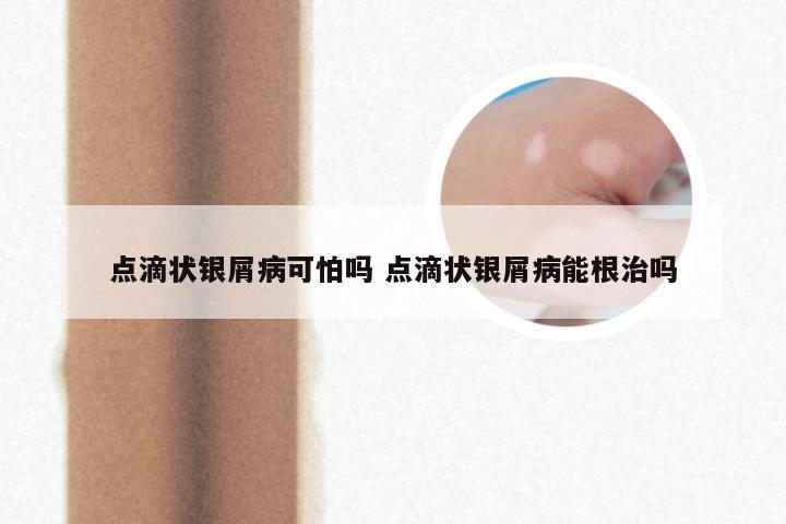 点滴状银屑病可怕吗 点滴状银屑病能根治吗