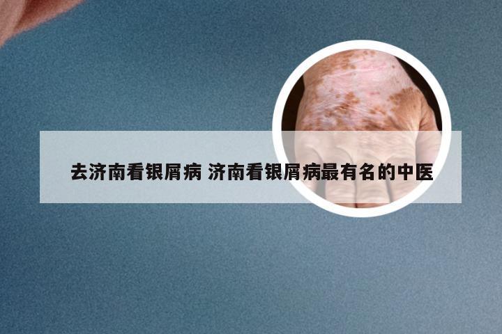 去济南看银屑病 济南看银屑病最有名的中医