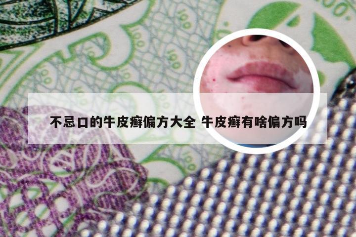 不忌口的牛皮癣偏方大全 牛皮癣有啥偏方吗