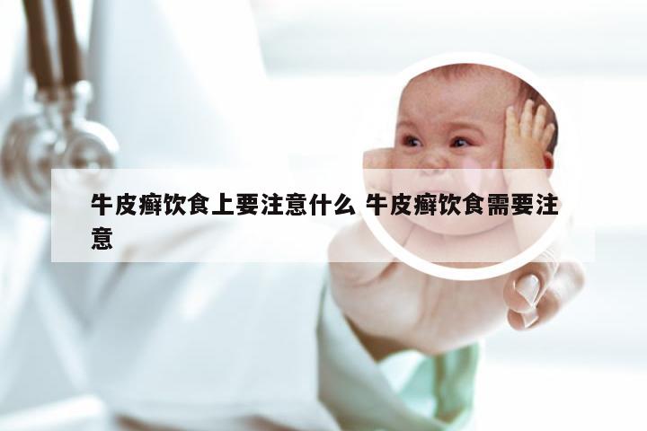 牛皮癣饮食上要注意什么 牛皮癣饮食需要注意
