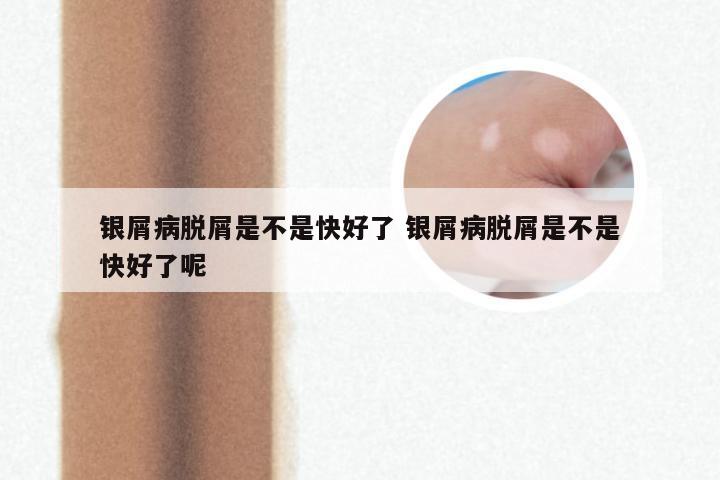 银屑病脱屑是不是快好了 银屑病脱屑是不是快好了呢