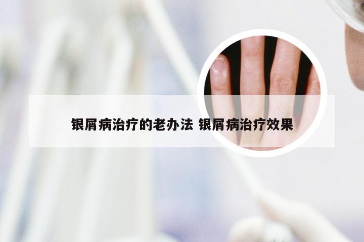银屑病治疗的老办法 银屑病治疗效果