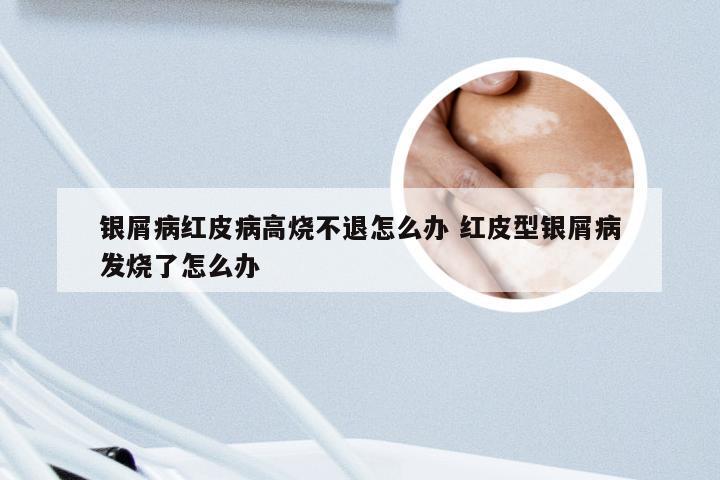 银屑病红皮病高烧不退怎么办 红皮型银屑病发烧了怎么办