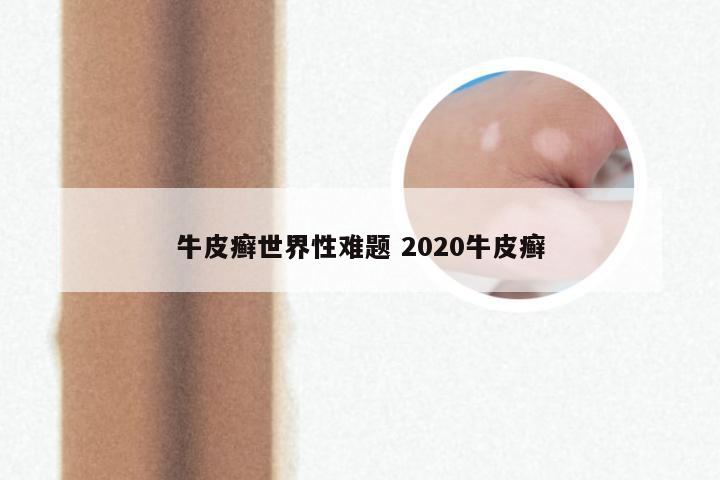 牛皮癣世界性难题 2020牛皮癣