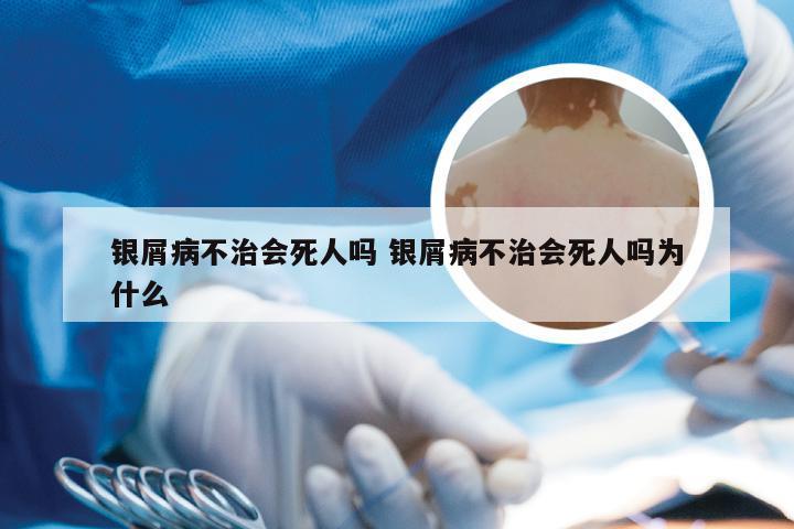 银屑病不治会死人吗 银屑病不治会死人吗为什么