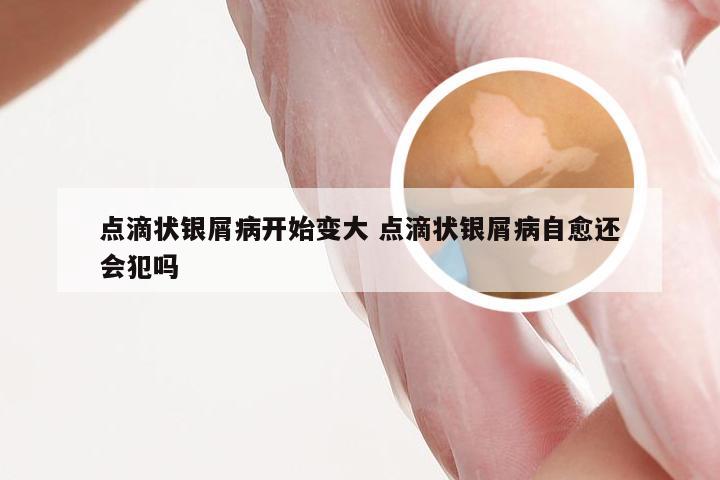 点滴状银屑病开始变大 点滴状银屑病自愈还会犯吗