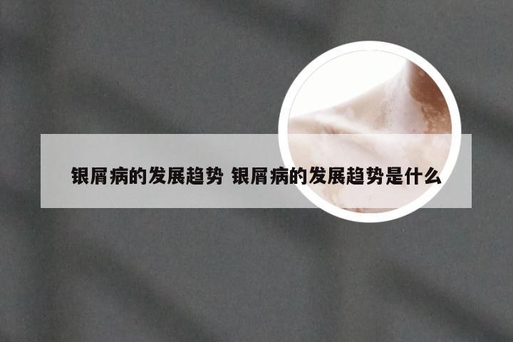 银屑病的发展趋势 银屑病的发展趋势是什么
