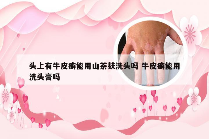 头上有牛皮癣能用山茶麸洗头吗 牛皮癣能用洗头膏吗