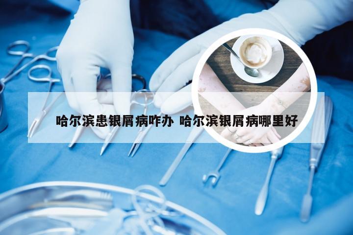哈尔滨患银屑病咋办 哈尔滨银屑病哪里好