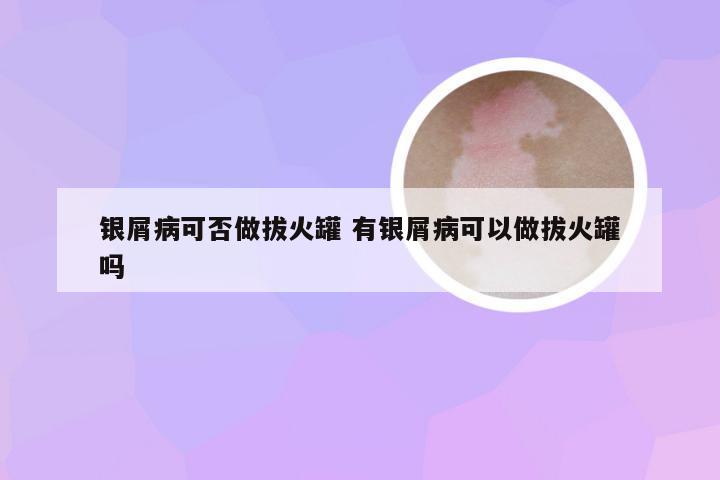 银屑病可否做拔火罐 有银屑病可以做拔火罐吗