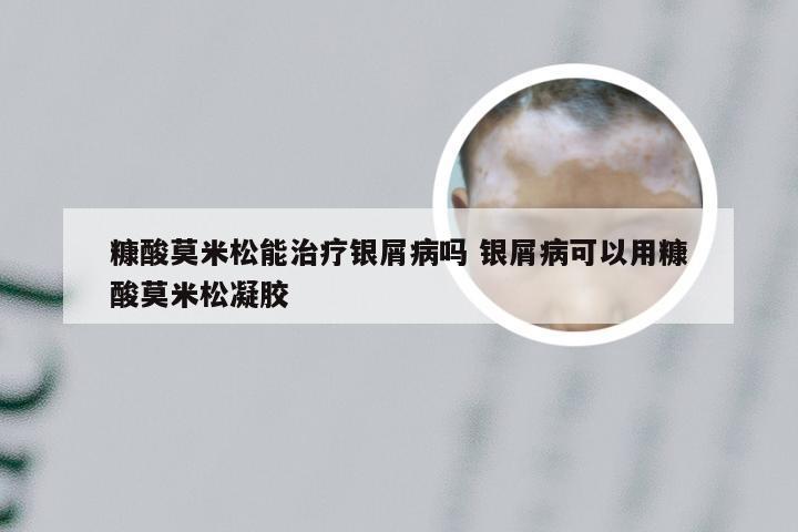 糠酸莫米松能治疗银屑病吗 银屑病可以用糠酸莫米松凝胶