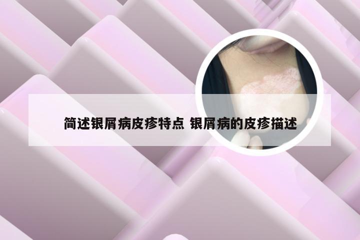 简述银屑病皮疹特点 银屑病的皮疹描述
