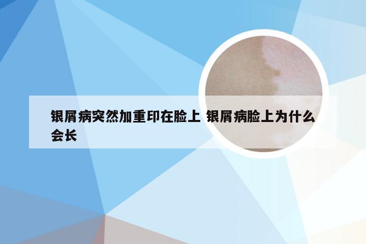 银屑病突然加重印在脸上 银屑病脸上为什么会长