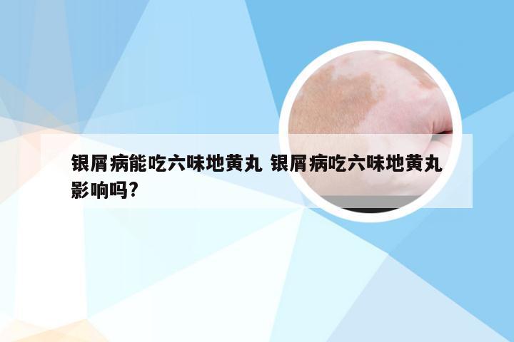 银屑病能吃六味地黄丸 银屑病吃六味地黄丸影响吗?