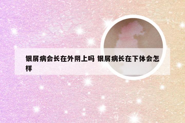 银屑病会长在外阴上吗 银屑病长在下体会怎样