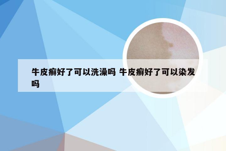 牛皮癣好了可以洗澡吗 牛皮癣好了可以染发吗