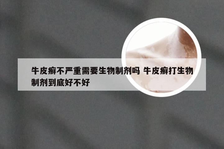 牛皮癣不严重需要生物制剂吗 牛皮癣打生物制剂到底好不好