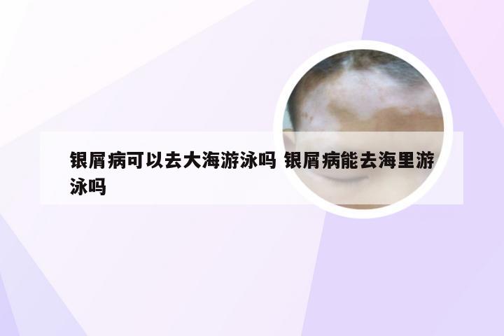 银屑病可以去大海游泳吗 银屑病能去海里游泳吗