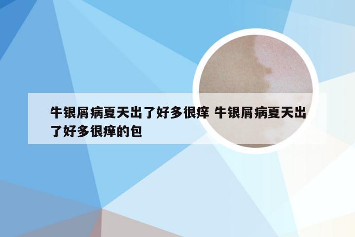 牛银屑病夏天出了好多很痒 牛银屑病夏天出了好多很痒的包
