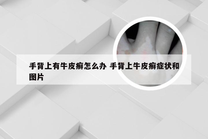 手背上有牛皮癣怎么办 手背上牛皮癣症状和图片