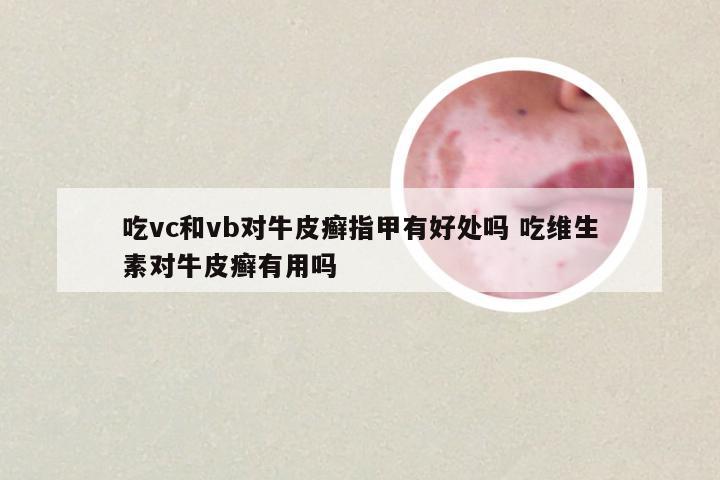 吃vc和vb对牛皮癣指甲有好处吗 吃维生素对牛皮癣有用吗