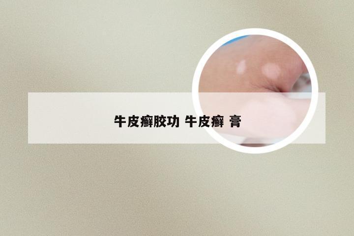 牛皮癣胶功 牛皮癣 膏