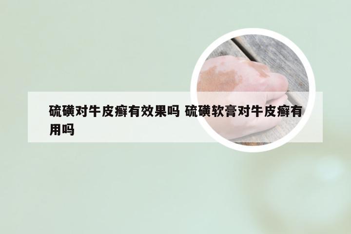 硫磺对牛皮癣有效果吗 硫磺软膏对牛皮癣有用吗