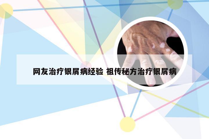 网友治疗银屑病经验 祖传秘方治疗银屑病