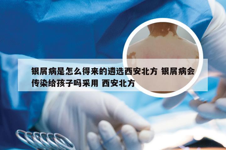 银屑病是怎么得来的遴选西安北方 银屑病会传染给孩子吗采用 西安北方