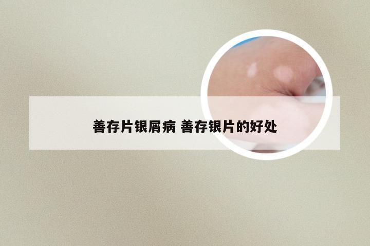 善存片银屑病 善存银片的好处