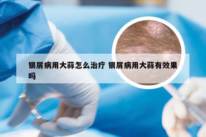 银屑病用大蒜怎么治疗 银屑病用大蒜有效果吗