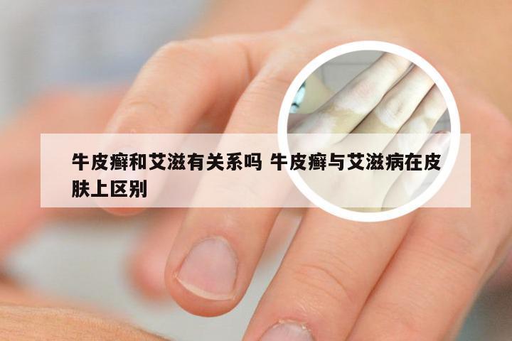 牛皮癣和艾滋有关系吗 牛皮癣与艾滋病在皮肤上区别