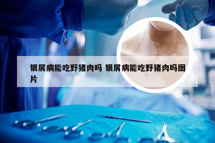 银屑病能吃野猪肉吗 银屑病能吃野猪肉吗图片