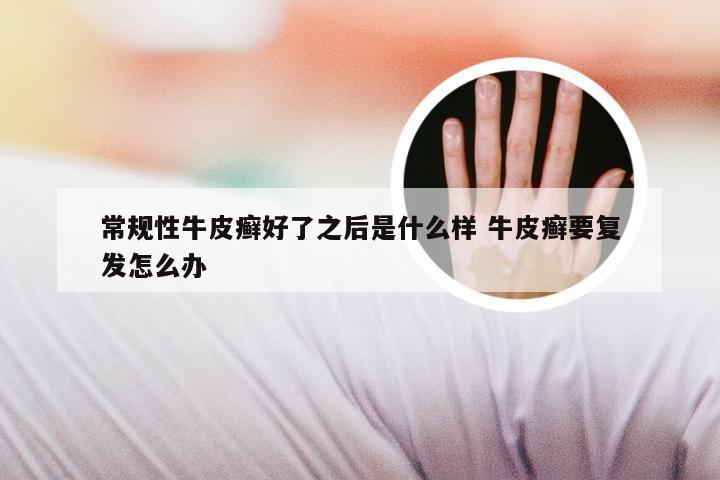 常规性牛皮癣好了之后是什么样 牛皮癣要复发怎么办