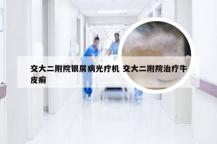 交大二附院银屑病光疔机 交大二附院治疗牛皮癣