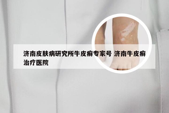 济南皮肤病研究所牛皮癣专家号 济南牛皮癣治疗医院