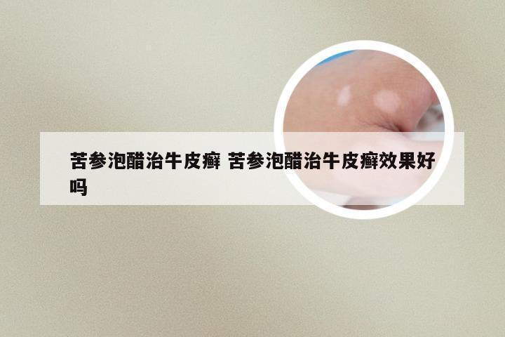 苦参泡醋治牛皮癣 苦参泡醋治牛皮癣效果好吗