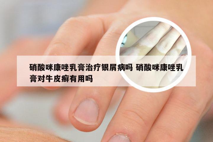 硝酸咪康唑乳膏治疗银屑病吗 硝酸咪康唑乳膏对牛皮癣有用吗
