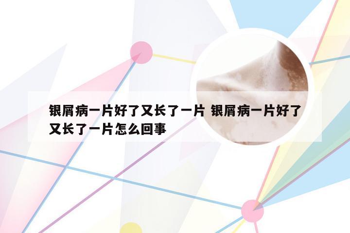 银屑病一片好了又长了一片 银屑病一片好了又长了一片怎么回事
